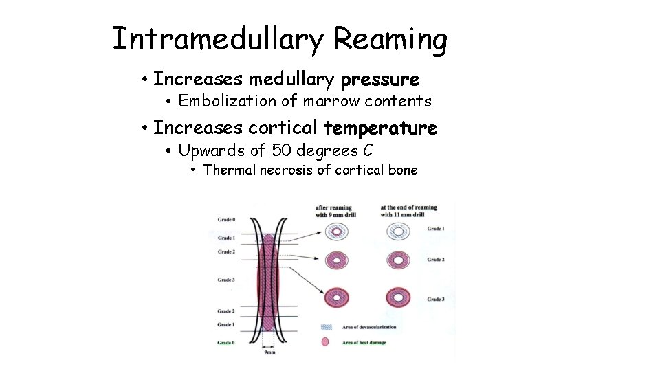 Intramedullary Reaming • Increases medullary pressure • Embolization of marrow contents • Increases cortical