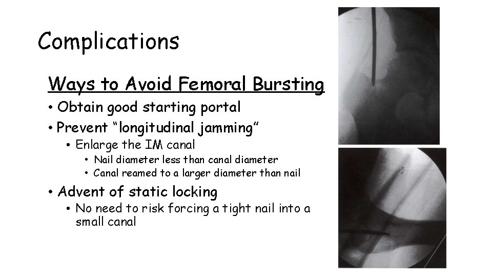 Complications Ways to Avoid Femoral Bursting • Obtain good starting portal • Prevent “longitudinal