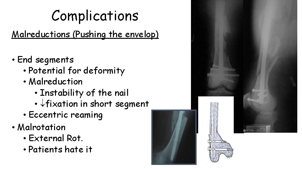 Complications Malreductions (Pushing the envelop) • End segments • Potential for deformity • Malreduction