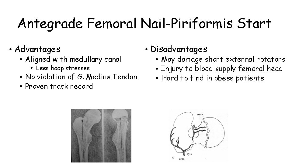 Antegrade Femoral Nail-Piriformis Start • Advantages • Aligned with medullary canal • Less hoop