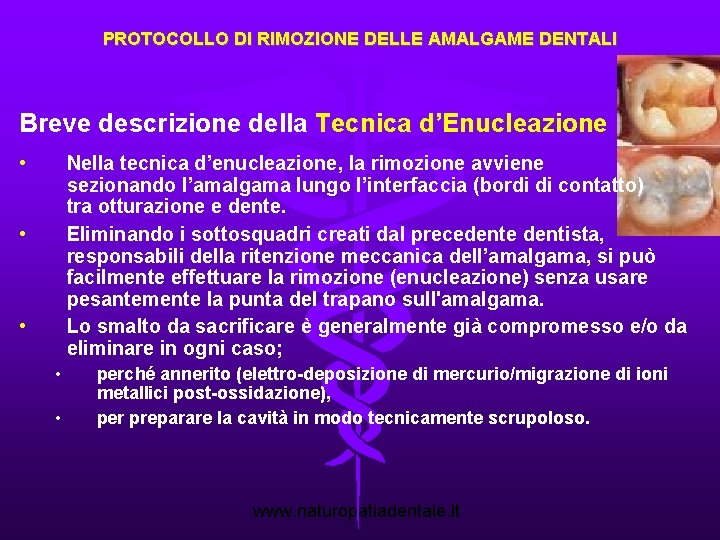 PROTOCOLLO DI RIMOZIONE DELLE AMALGAME DENTALI Breve descrizione della Tecnica d’Enucleazione • Nella tecnica