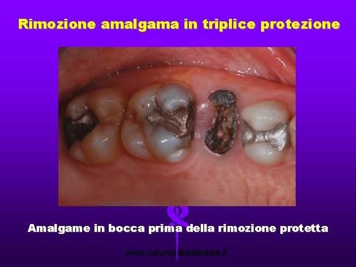 Rimozione amalgama in triplice protezione Amalgame in bocca prima della rimozione protetta www. naturopatiadentale.