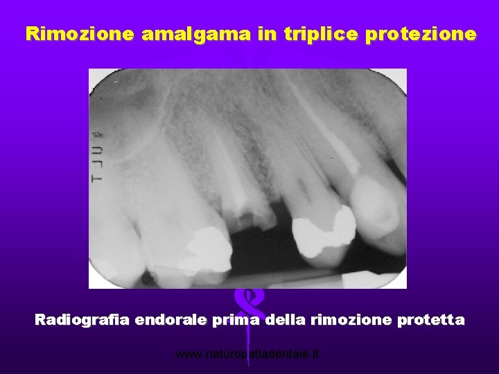 Rimozione amalgama in triplice protezione Radiografia endorale prima della rimozione protetta www. naturopatiadentale. it