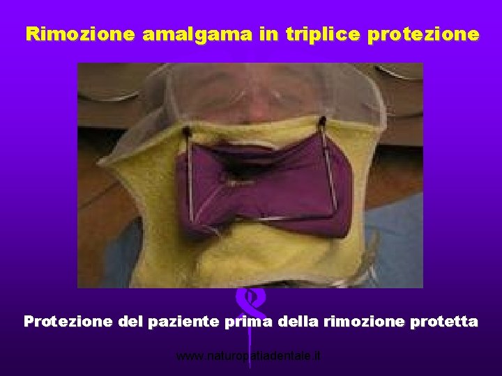 Rimozione amalgama in triplice protezione Protezione del paziente prima della rimozione protetta www. naturopatiadentale.