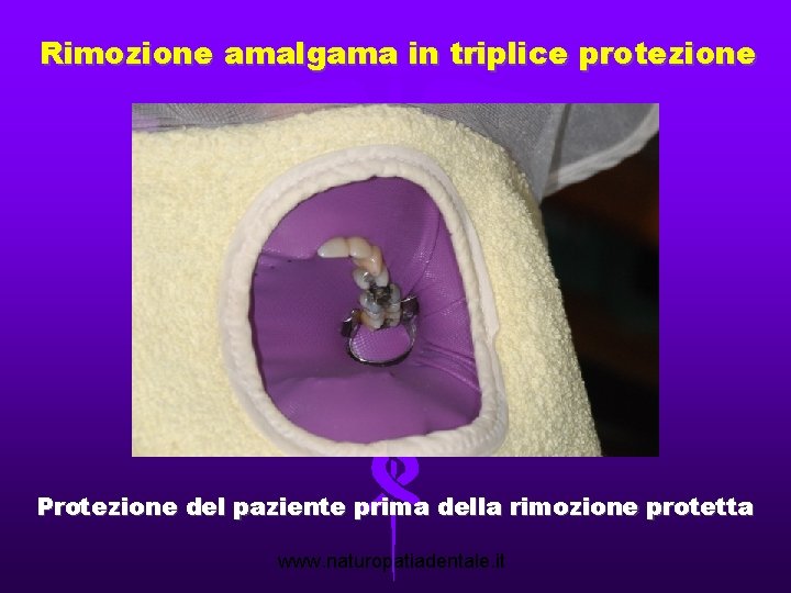 Rimozione amalgama in triplice protezione Protezione del paziente prima della rimozione protetta www. naturopatiadentale.