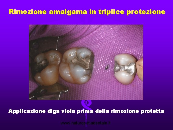 Rimozione amalgama in triplice protezione Applicazione diga viola prima della rimozione protetta www. naturopatiadentale.