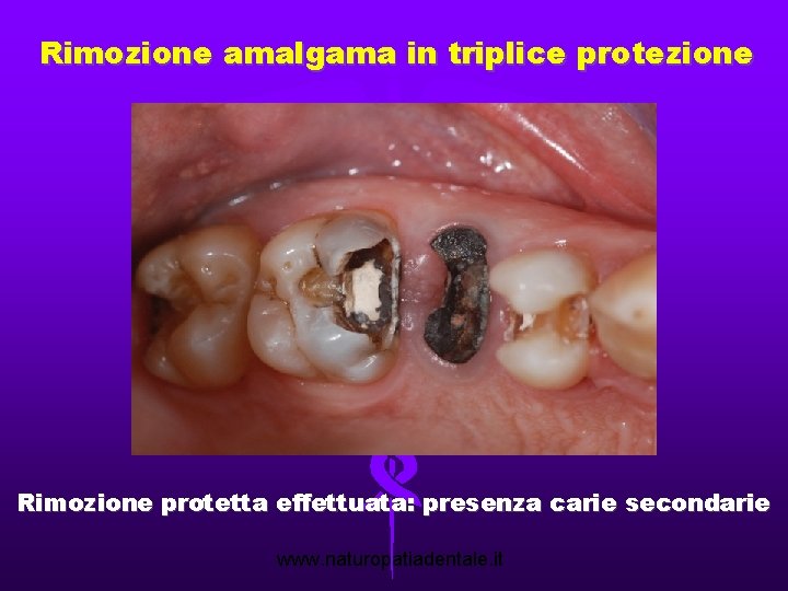 Rimozione amalgama in triplice protezione Rimozione protetta effettuata: presenza carie secondarie www. naturopatiadentale. it