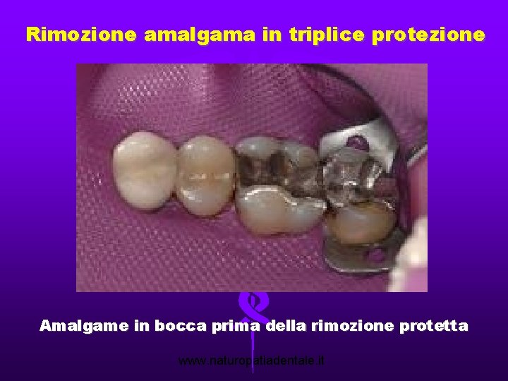 Rimozione amalgama in triplice protezione Amalgame in bocca prima della rimozione protetta www. naturopatiadentale.