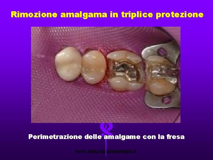 Rimozione amalgama in triplice protezione Perimetrazione delle amalgame con la fresa www. naturopatiadentale. it