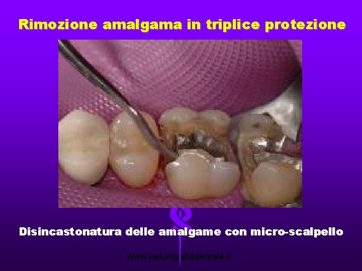 Rimozione amalgama in triplice protezione Disincastonatura delle amalgame con micro-scalpello www. naturopatiadentale. it 