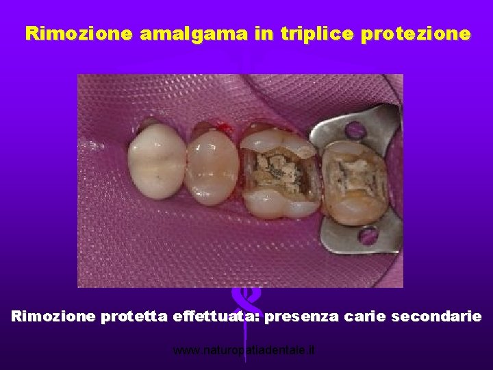 Rimozione amalgama in triplice protezione Rimozione protetta effettuata: presenza carie secondarie www. naturopatiadentale. it