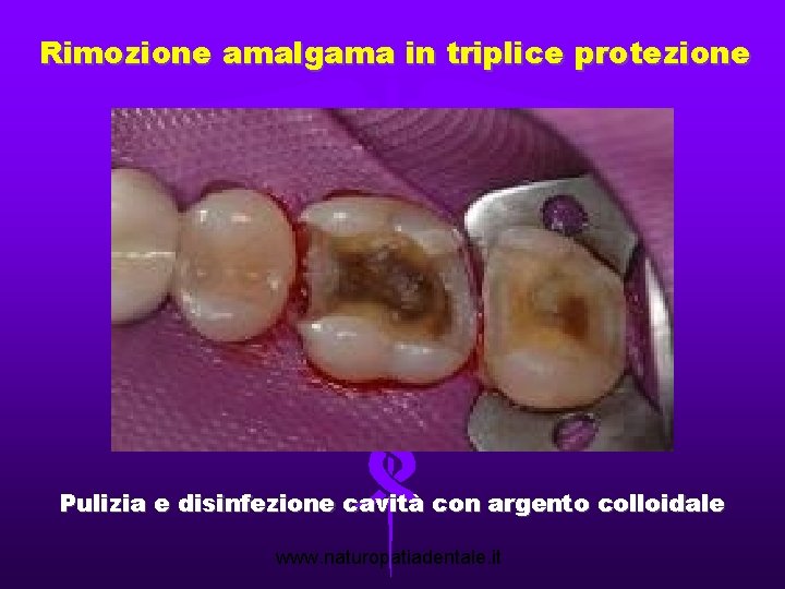 Rimozione amalgama in triplice protezione Pulizia e disinfezione cavità con argento colloidale www. naturopatiadentale.