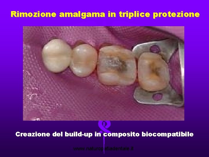 Rimozione amalgama in triplice protezione Creazione del build-up in composito biocompatibile www. naturopatiadentale. it