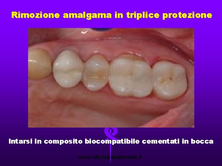 Rimozione amalgama in triplice protezione Intarsi in composito biocompatibile cementati in bocca www. naturopatiadentale.