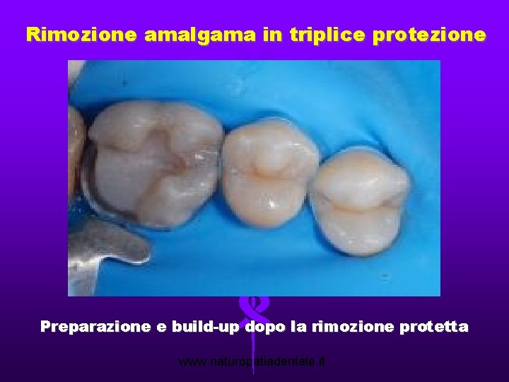 Rimozione amalgama in triplice protezione Preparazione e build-up dopo la rimozione protetta www. naturopatiadentale.