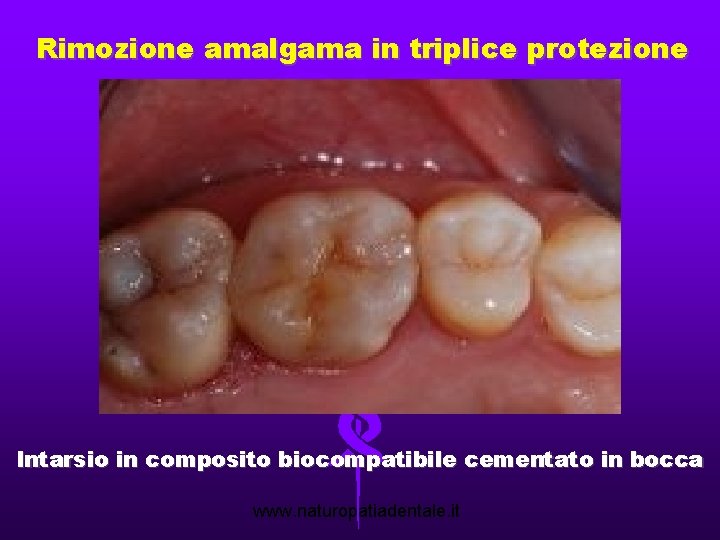 Rimozione amalgama in triplice protezione Intarsio in composito biocompatibile cementato in bocca www. naturopatiadentale.