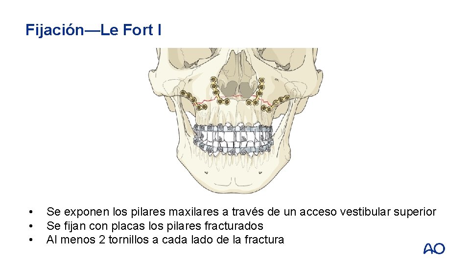 Fijación—Le Fort I • • • Se exponen los pilares maxilares a través de