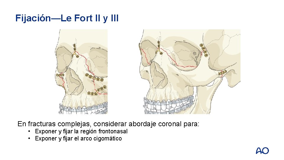 Fijación—Le Fort II y III En fracturas complejas, considerar abordaje coronal para: • Exponer