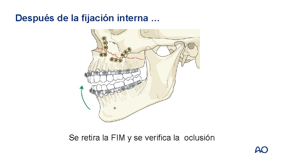 Después de la fijación interna … Se retira la FIM y se verifica la