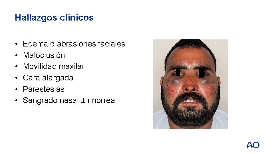 Hallazgos clínicos • • • Edema o abrasiones faciales Maloclusión Movilidad maxilar Cara alargada