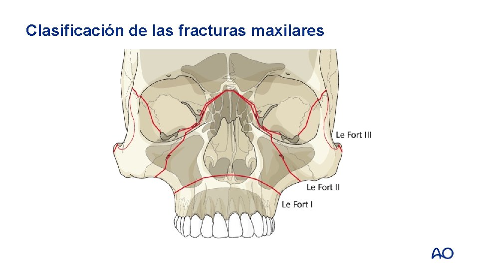 Clasificación de las fracturas maxilares 