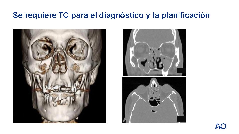 Se requiere TC para el diagnóstico y la planificación 