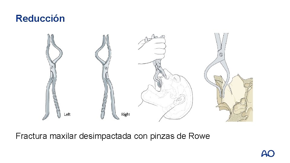 Reducción Fractura maxilar desimpactada con pinzas de Rowe 