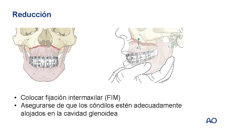 Reducción • Colocar fijación intermaxilar (FIM) • Asegurarse de que los cóndilos estén adecuadamente