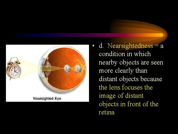  • d. Nearsightedness = a condition in which nearby objects are seen more
