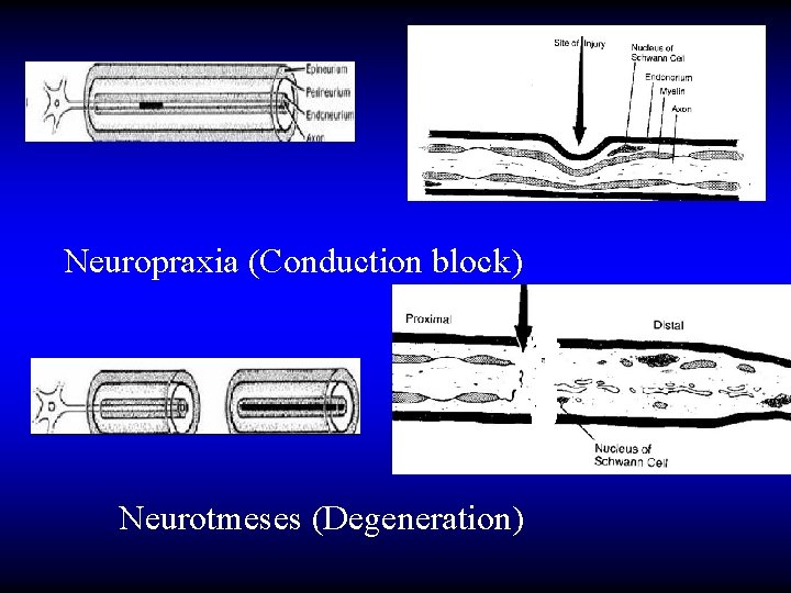 Neuropraxia (Conduction block) Neurotmeses (Degeneration) 