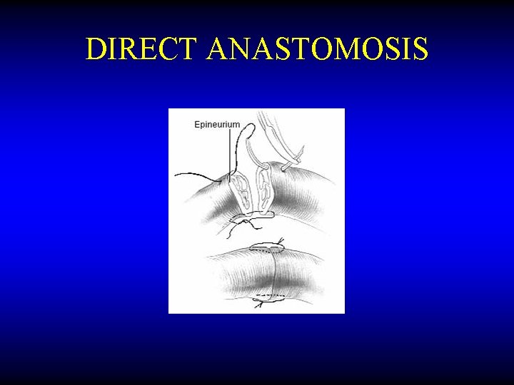 DIRECT ANASTOMOSIS 