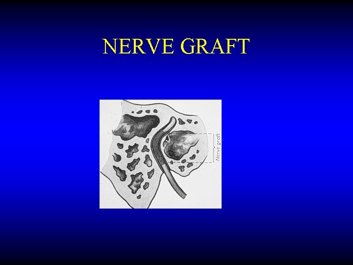 NERVE GRAFT 