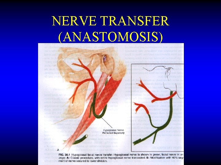 NERVE TRANSFER (ANASTOMOSIS) 