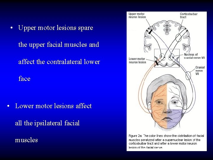  • Upper motor lesions spare the upper facial muscles and affect the contralateral