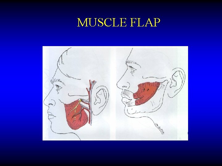 MUSCLE FLAP 