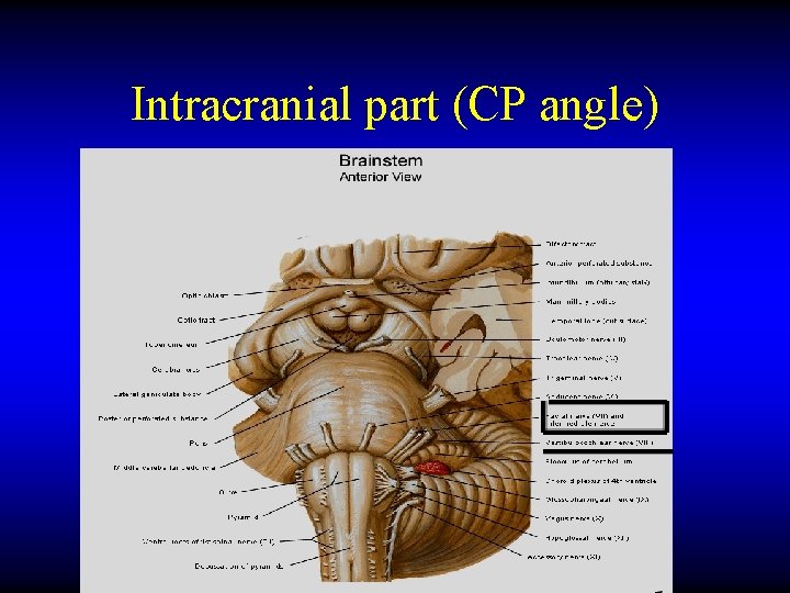 Intracranial part (CP angle) 