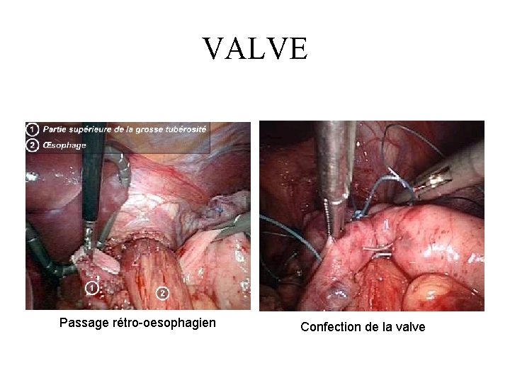 VALVE Passage rétro-oesophagien Confection de la valve 