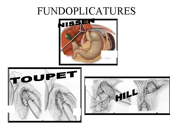 FUNDOPLICATURES 