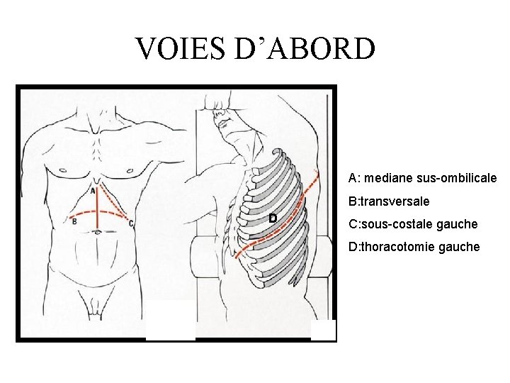 VOIES D’ABORD A: mediane sus-ombilicale B: transversale D C: sous-costale gauche D: thoracotomie gauche