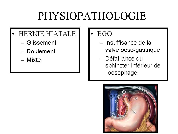 PHYSIOPATHOLOGIE • HERNIE HIATALE – Glissement – Roulement – Mixte • RGO – Insuffisance