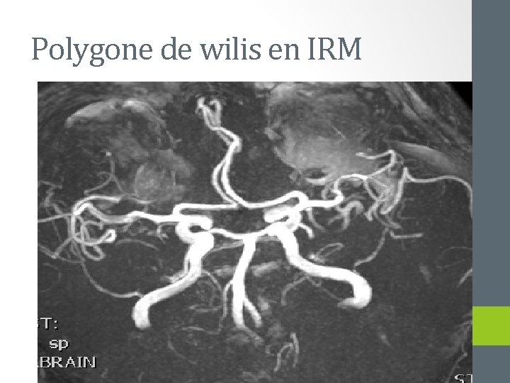 Polygone de wilis en IRM 