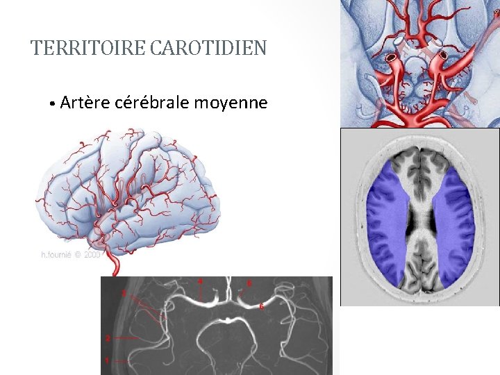 TERRITOIRE CAROTIDIEN • Artère cérébrale moyenne 