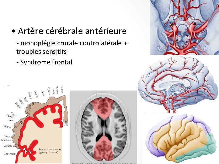  • Artère cérébrale antérieure - monoplégie crurale controlatérale + troubles sensitifs - Syndrome