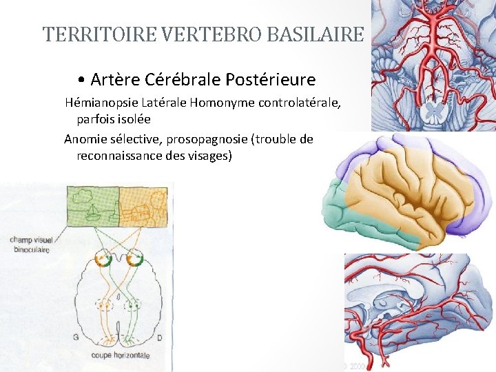 TERRITOIRE VERTEBRO BASILAIRE • Artère Cérébrale Postérieure - Hémianopsie Latérale Homonyme controlatérale, parfois isolée
