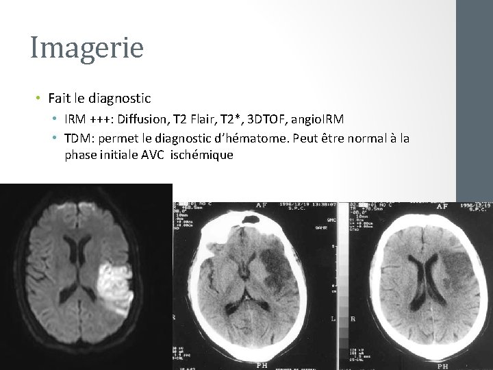 Imagerie • Fait le diagnostic • IRM +++: Diffusion, T 2 Flair, T 2*,
