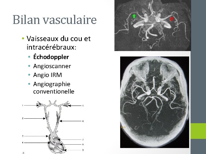 Bilan vasculaire • Vaisseaux du cou et intracérébraux: • • Échodoppler Angioscanner Angio IRM