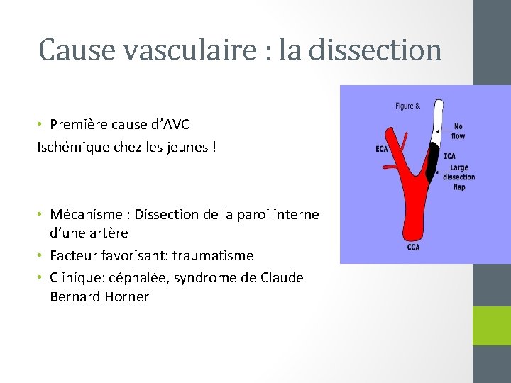 Cause vasculaire : la dissection • Première cause d’AVC Ischémique chez les jeunes !