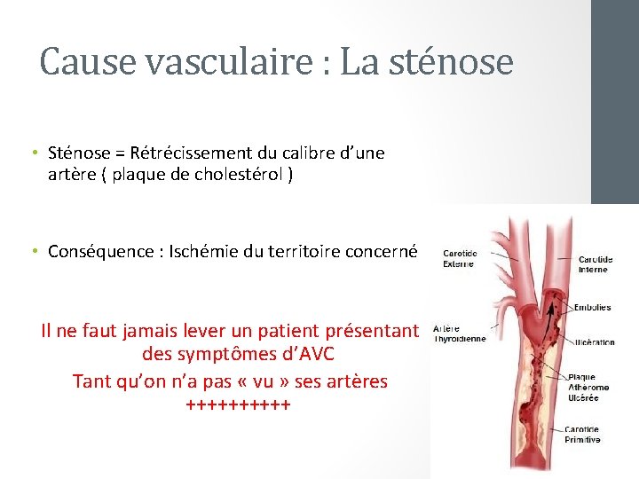 Cause vasculaire : La sténose • Sténose = Rétrécissement du calibre d’une artère (