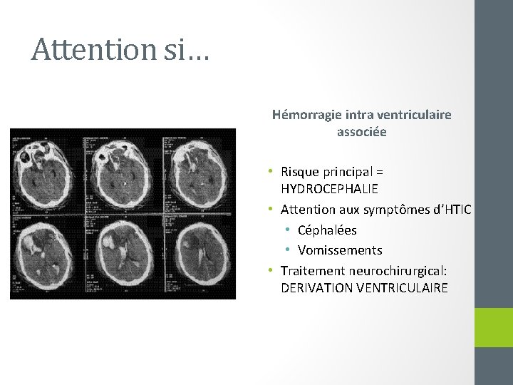 Attention si… Hémorragie intra ventriculaire associée • Risque principal = HYDROCEPHALIE • Attention aux