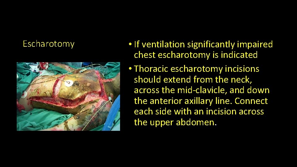 Escharotomy • If ventilation significantly impaired chest escharotomy is indicated • Thoracic escharotomy incisions